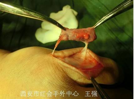 血管蒂