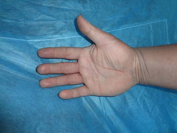 术后1年皮瓣外观