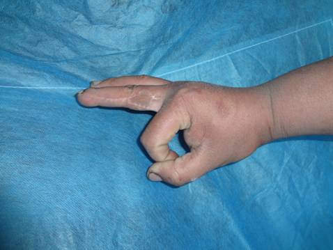 术后1年供区外观