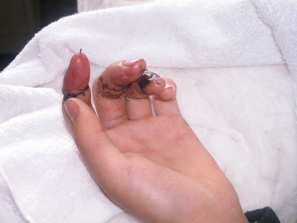 3个手指末节断指18个小时后，行断指再植，仅用不到4个小时完成手术，术后全部成活