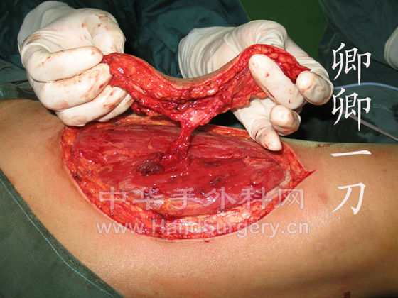皮瓣4.jpg