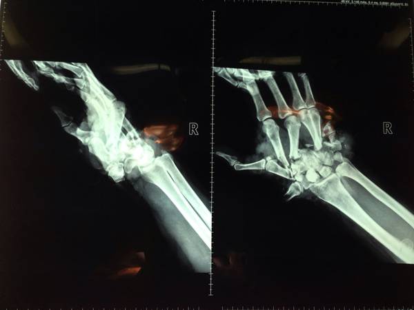 腕骨掌骨粉碎关系紊乱