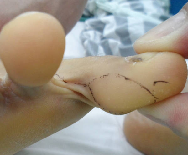 足踇趾腓侧皮瓣修复
