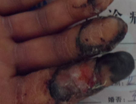 术后2周指尖部分表皮坏死