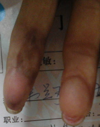 术后半年情况
