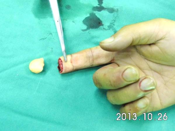 右食指末节剪板机致伤