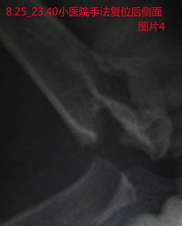 04_8.25_23.40小医院手法复位后侧面.jpg