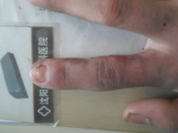 耿真龙 示指筋膜蒂岛状皮瓣 术后2个月 (2).JPG