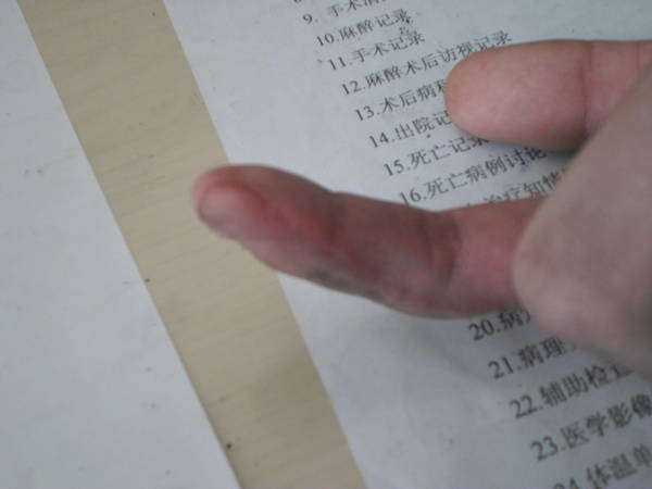 耿真龙 示指筋膜蒂岛状皮瓣 术后2个月.JPG
