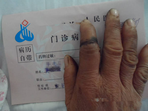 术后2周