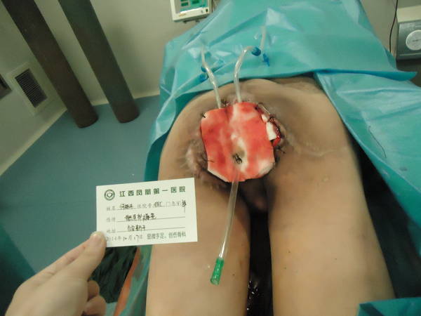 何福平 骶尾部褥疮 (1).JPG