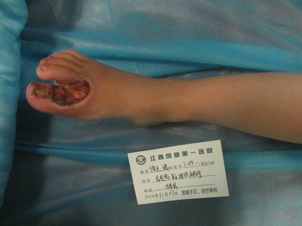 徐正瑞 右足皮肤缺损 .JPG