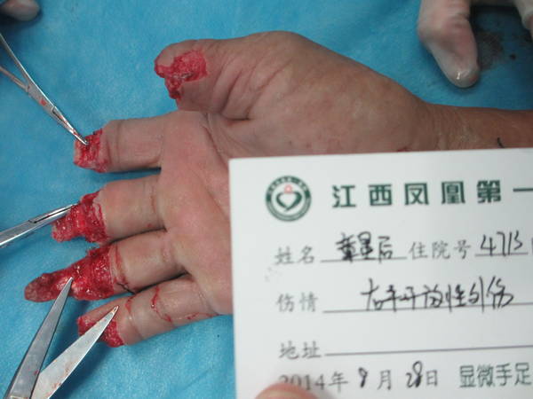 清创后