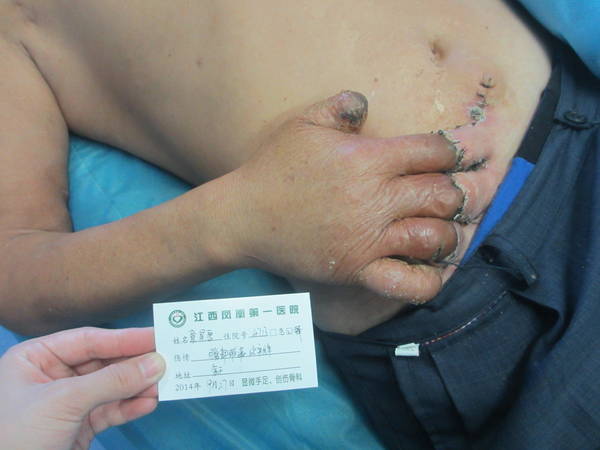 腹部皮瓣修复