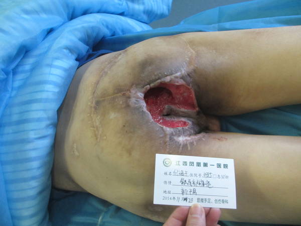 何福平   骶尾部褥疮（1）.JPG