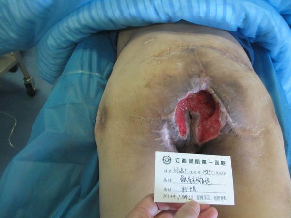 何福平   骶尾部褥疮（2）.JPG