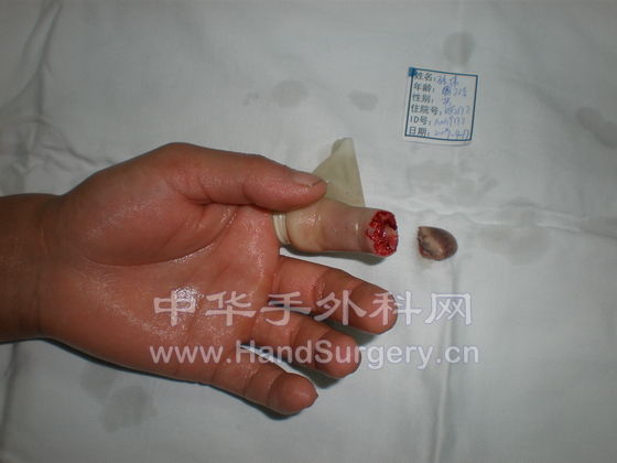 孙伟090417-甲根部撕脱离断2A1V指体严重碾挫.JPG