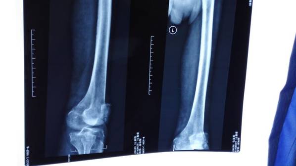 左膝关节片