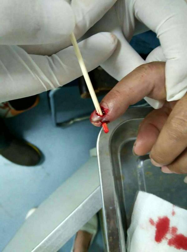 甲床中部缺损1.jpg