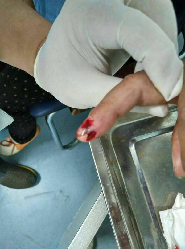 甲床中部缺损2.jpg