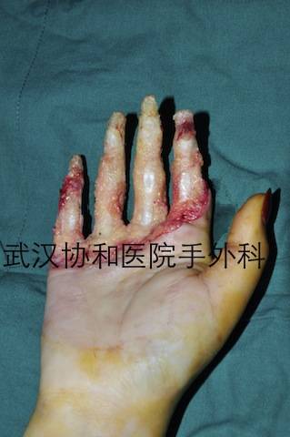 朱柯莹，女2岁，左手不全离断 (7).JPG