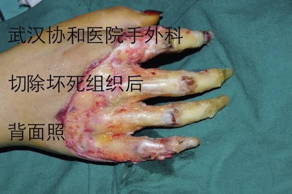 朱柯莹，女2岁，左手不全离断 (8).JPG