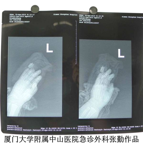 术前X光片，关节处离断