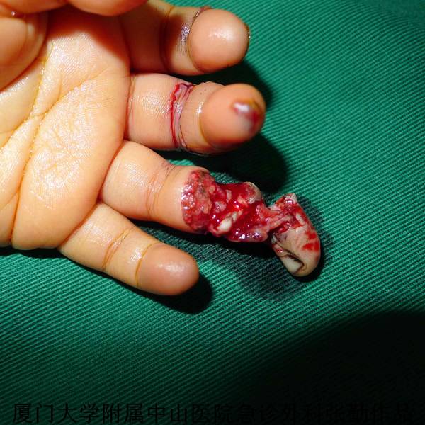 组织挫伤重