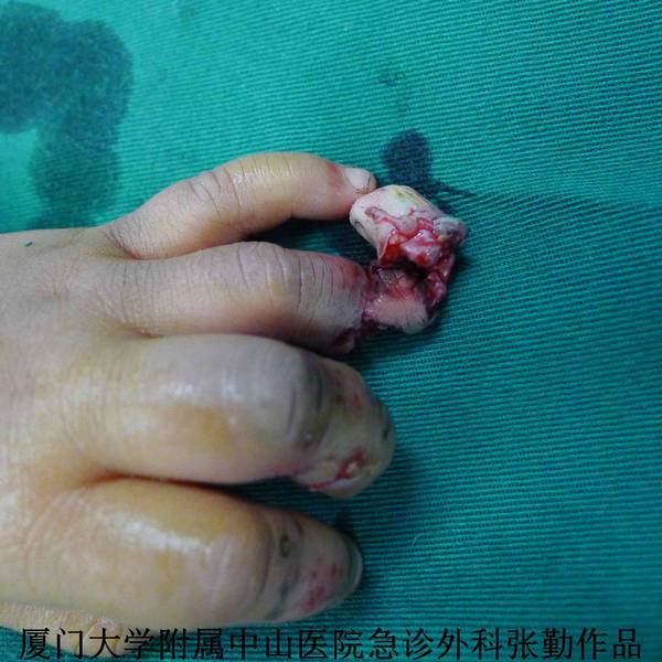 背侧于甲根处离断