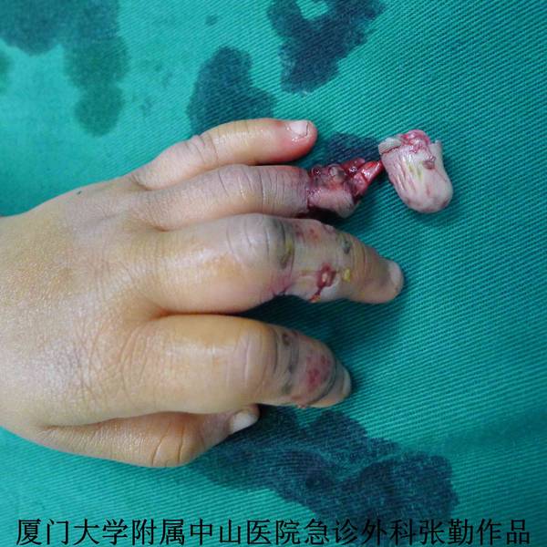 相连组织少