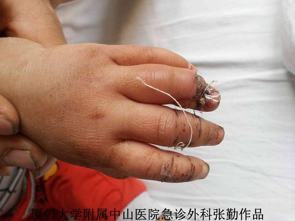 术后9天