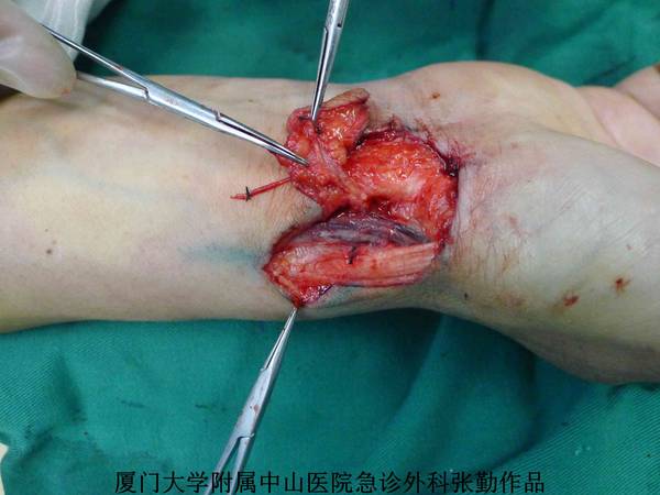 皮瓣切取