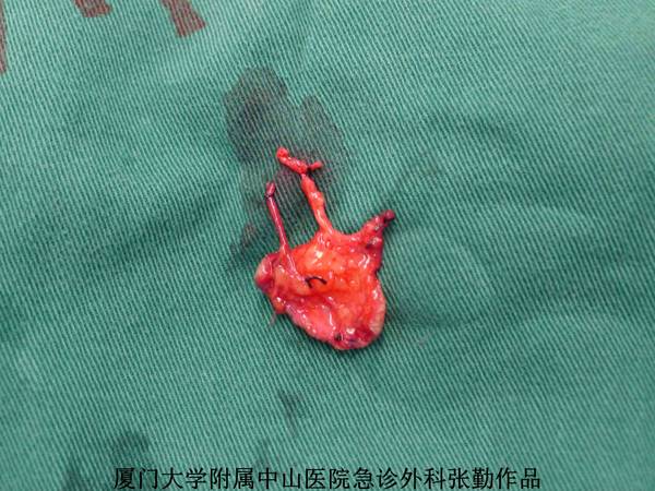 皮瓣切取