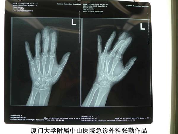 左手术前X光片