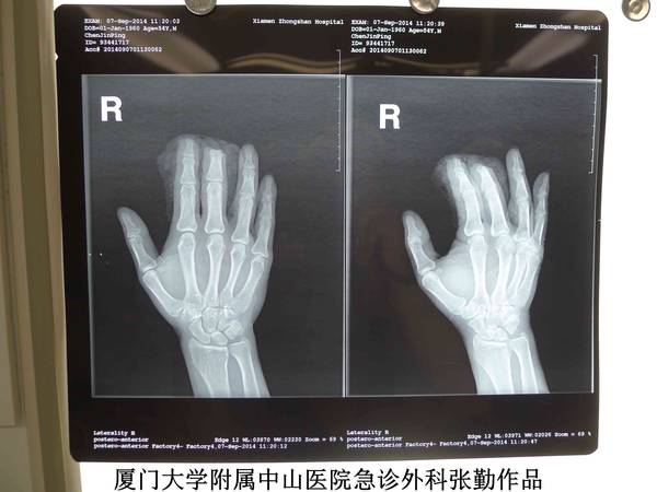 右手术前X光片