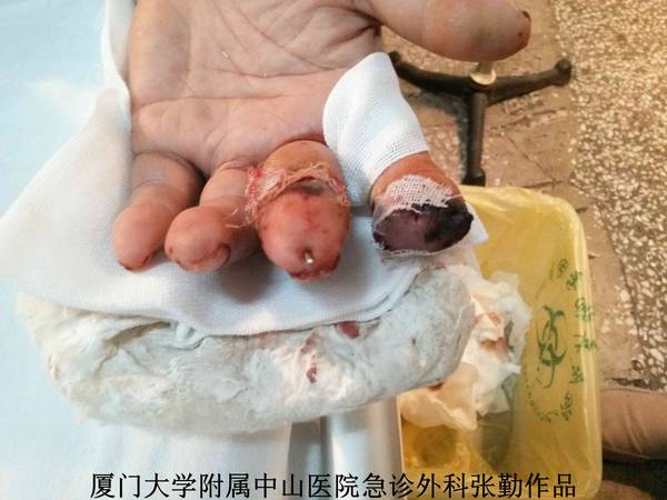 左手术后2天