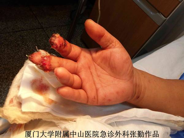 右手术后2天