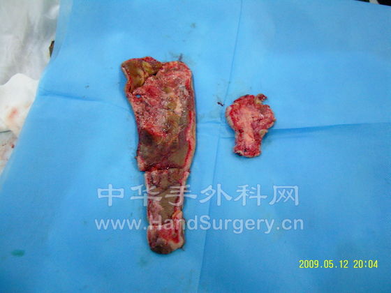 切除的坏死组织1.jpg