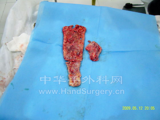 切除的坏死组织2.jpg