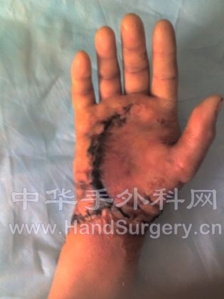 皮缘部分坏死。