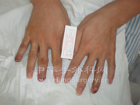 袁天伦指动脉皮瓣.JPG