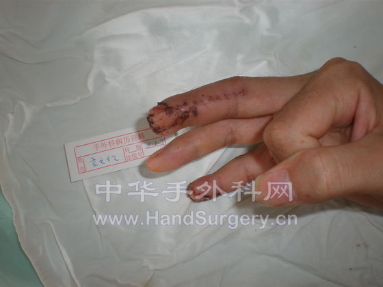 080909顺行指动脉皮瓣.JPG