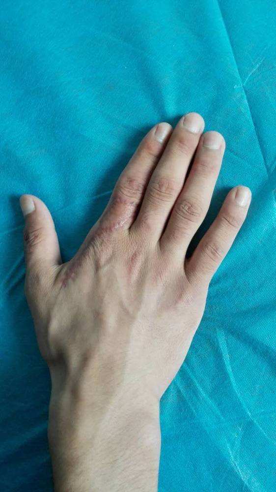术后一个月功能良好