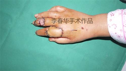 术后1周
