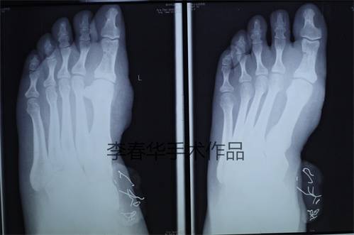 术后1周