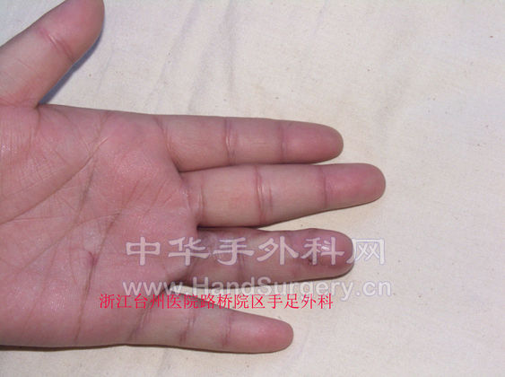 4，术后一个月.jpg
