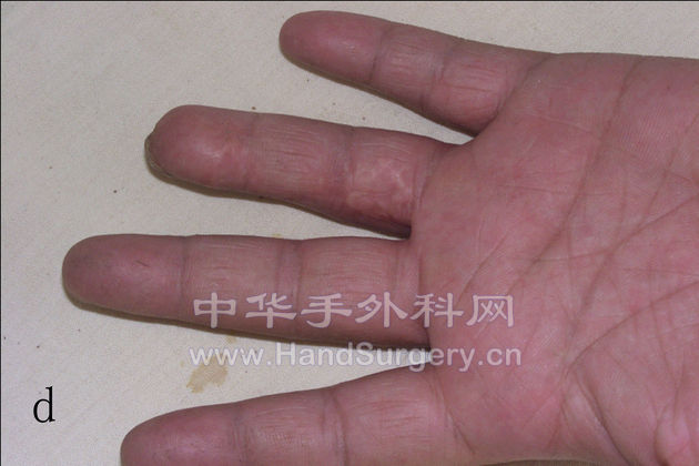 d，术后5年正面观.jpg