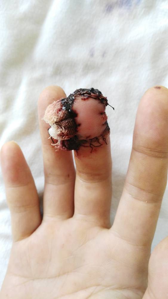 按照王老师的方法做了一例