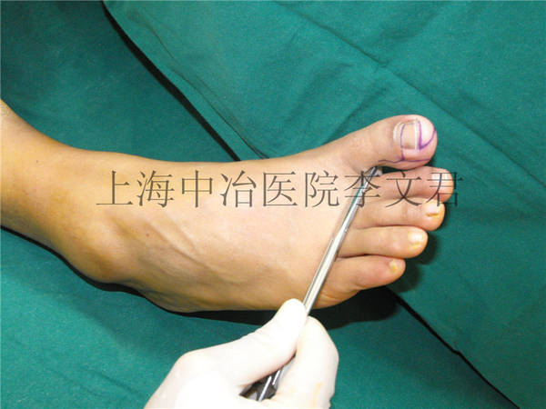 足部设计
