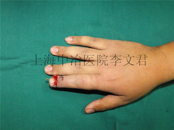 安装